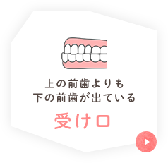 上の前歯よりも下の前歯が出ている 受け口