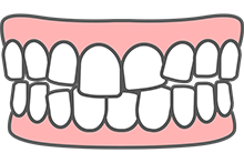 軽度の乱ぐい歯