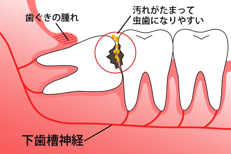 親知らずとは？