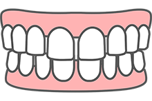空隙歯列(すきっ歯)