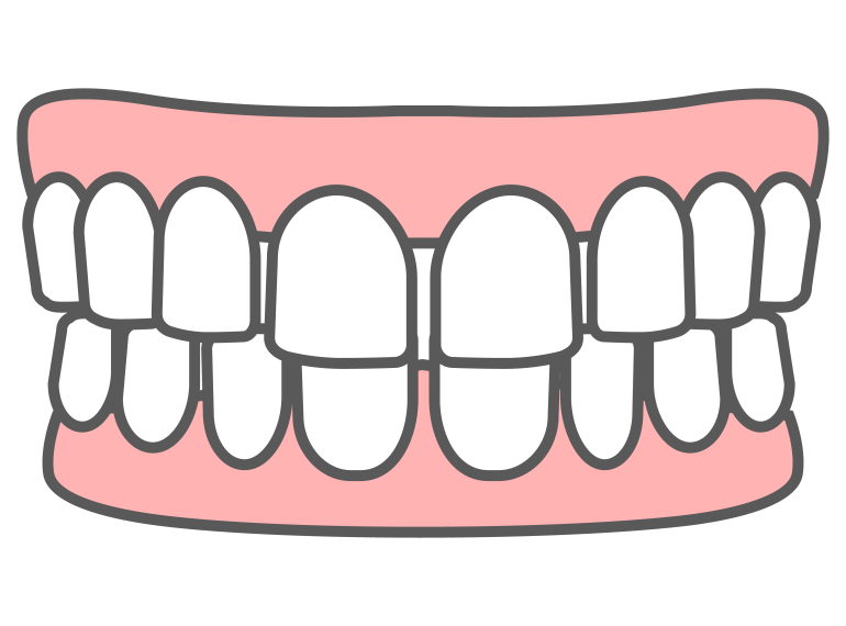 すきっ歯とは？